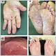 blister in gums from hand feet and moth disease