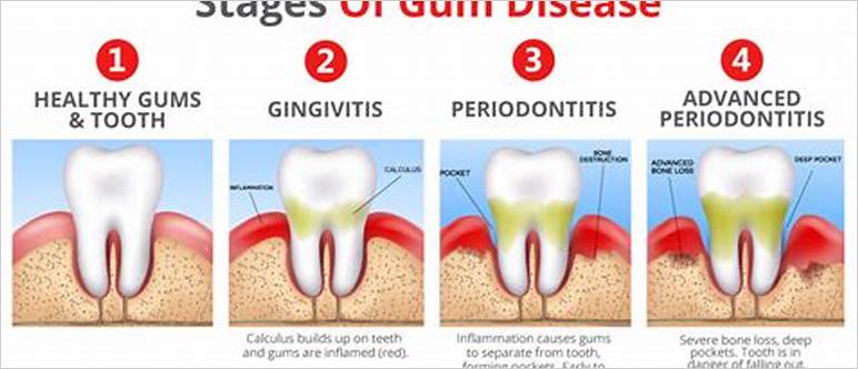 developing gum disease