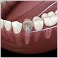flossing around dental implants