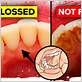 gum disease from not flossing