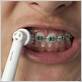 electric toothbrush braces