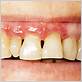 gum disease treatment in whittier