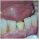 calcification in gums