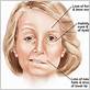 can gum disease cause bell's palsy