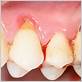 gum disease hole in gum