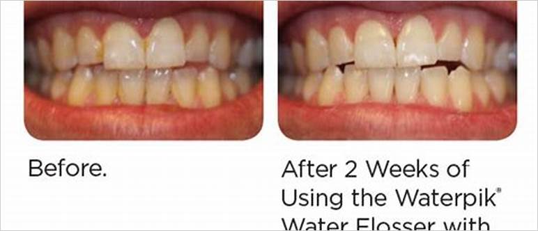 gums hurt after waterpik