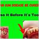 can gum disease be cured by brushing