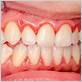 gum disease gingivitis is it contagious