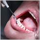 gum disease treatment in bangalore
