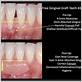 gum grafts for periodontal disease