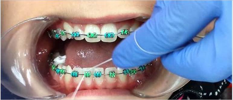 how to floss with braces without threader