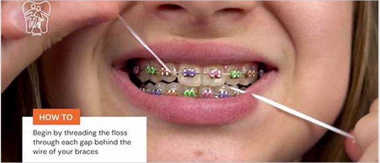 how to floss with braces without threader