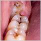 can impacted wisdom teeth cause gum disease
