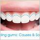 does water flossing cause gum recession