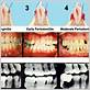 a type of periodontal disease in the gums