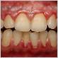 a type of periodontal disease restricted to gums