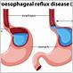 acid reflux and gum disease