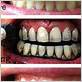 activated charcoal and gum disease