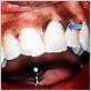 addisons disease gums