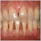 advance gum disease bone showing