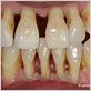 advanced gum disease loose teeth