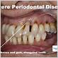 advanced gum disease symptoms