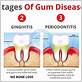 advanced gum diseases increase
