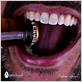 alcohol gum disease tooth decat