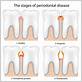 alexandria periodontal gum disease