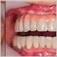 all on 4 implants gum disease
