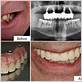 all on-4 dental implants gum disease