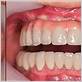 all-on-4 dental implants gum disease
