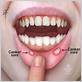 are canker sores and gum disease related