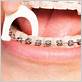 are flossing braces healthy