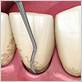 arlington gum disease treatment