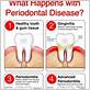 articles on gum disease