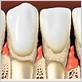 aspen dental gum disease