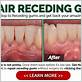 at home gum repair