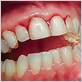 auburn gum disease