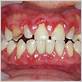 autoimmune diseases that cause gum inflammation