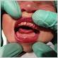 baby gum disease