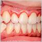 bad gingivitis pictures