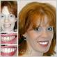 before and after gingivitis treatment