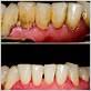 before and after pics of gum disease
