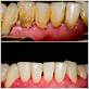 before and after pictures of treatment for gum disease