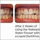 before and after using waterpik