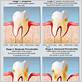 beginning of tobacco gum disease