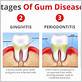 beginning stages of periodontal gum disease