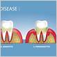 belleair gum disease treatment