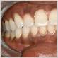 black gums disease pictures